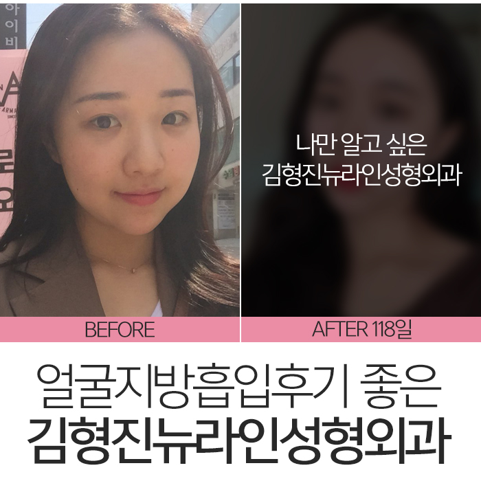 얼굴지방흡입후기 완벽 변신! 관련 이미지 3