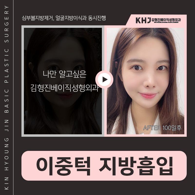턱라인지방흡입 후기도 좋아 관련 이미지 6
