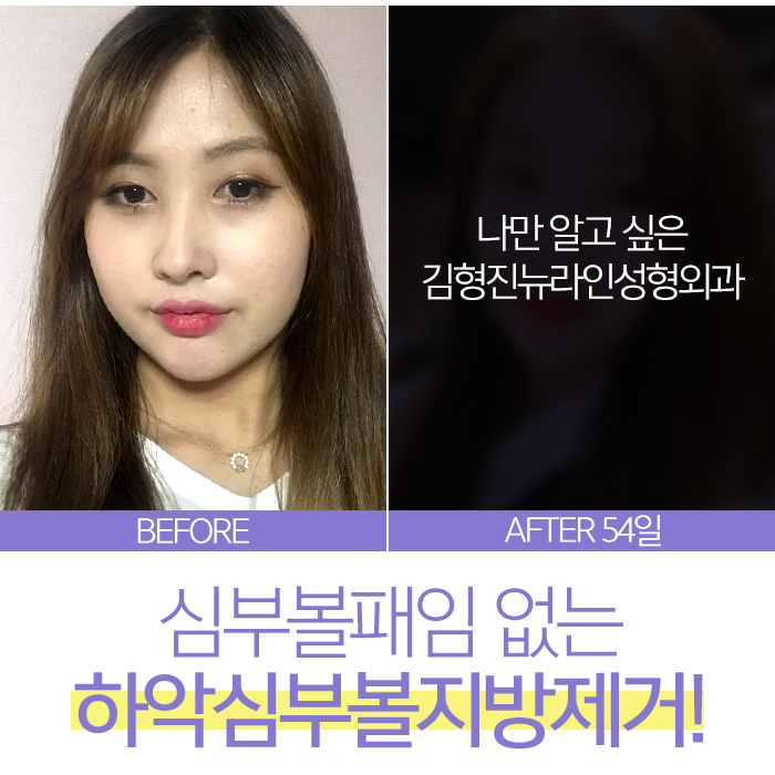 심부볼패임 무조건 온다고? 관련 이미지 3