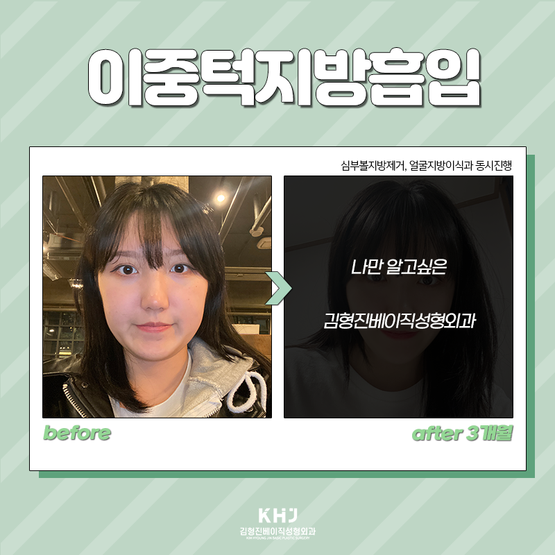 이중턱지방흡입전후 확인하고 가세요! 관련 이미지 5