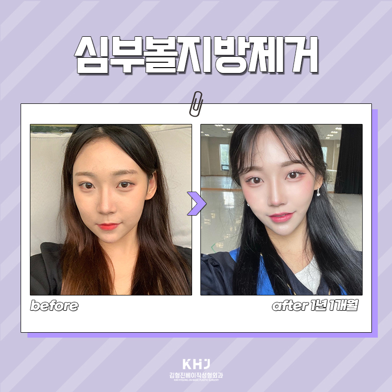 볼살제거수술 이거 하나면 확 달라집니다! 관련 이미지 6