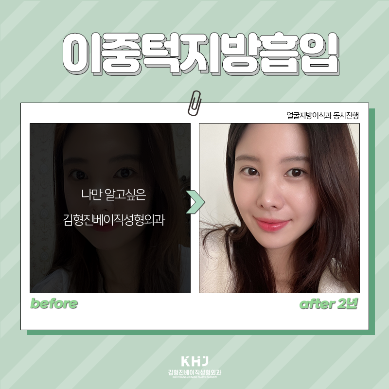 이중턱지방흡입후기 찾아보고 계셨죠? 관련 이미지 6