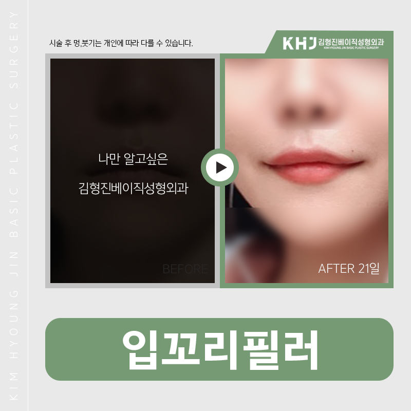 입꼬리필러후기 보고싶으신분 모여라! 관련 이미지 3