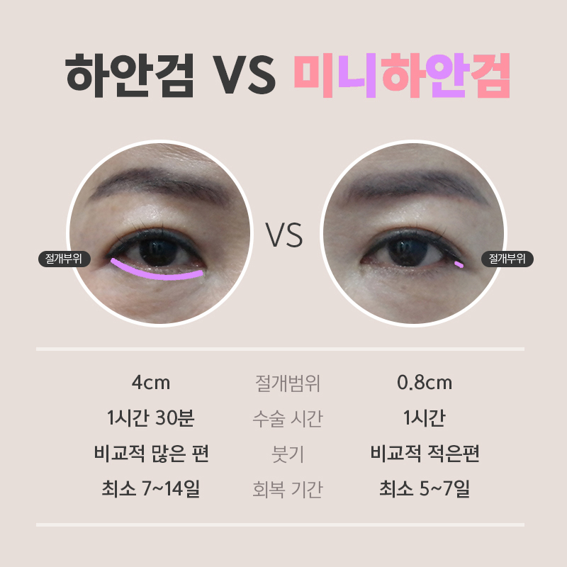 미니하안검전후 변화과정 확인하세요! 관련 이미지 5