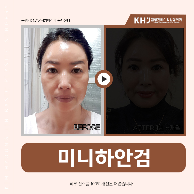 Solving Under-Eye Surgery for Middle Age with Mini Lower Blepharoplasty! image 5