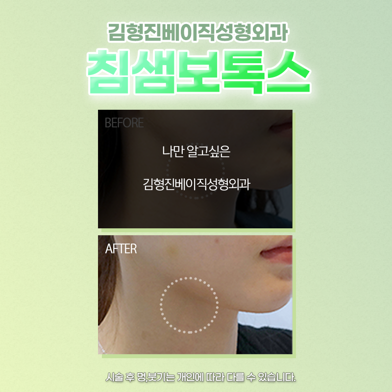 침샘보톡스효과 아직도 모르셨다면 관련 이미지 6