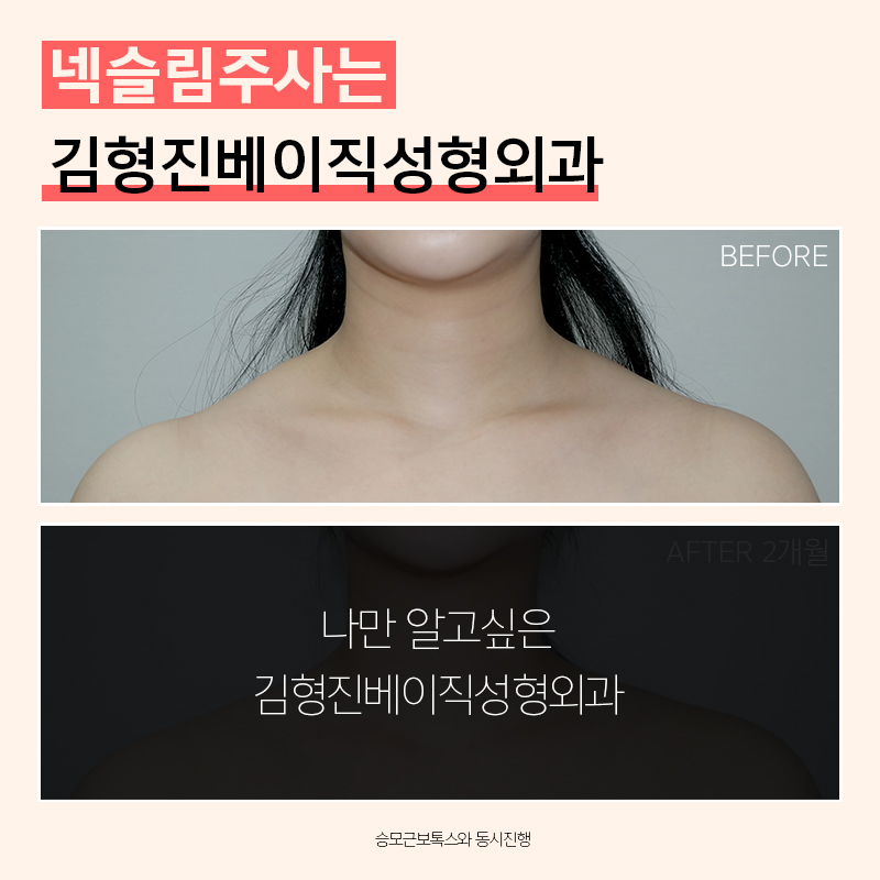 두꺼운목선, 과연 갸름해질 수 있을까? 관련 이미지 2