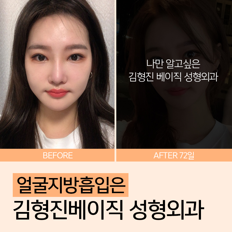 소프트브이라인! 나의 비포애프터가 궁금해 관련 이미지 6