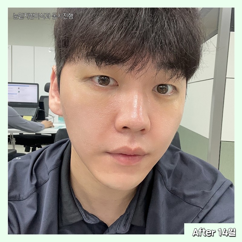 눈밑지방재배치유지력 오래가는 곳 찾으셨다면 관련 이미지 5