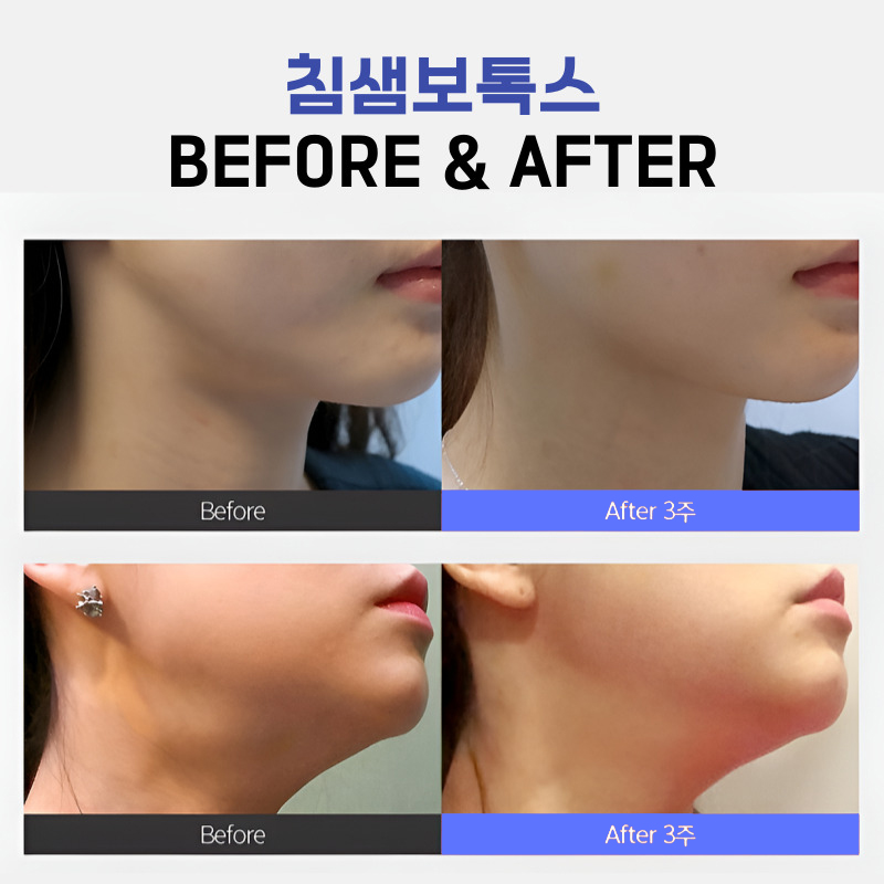 턱밑침샘보톡스로 얼굴선은 살리고, 턱 밑은 가볍게! 관련 이미지 6