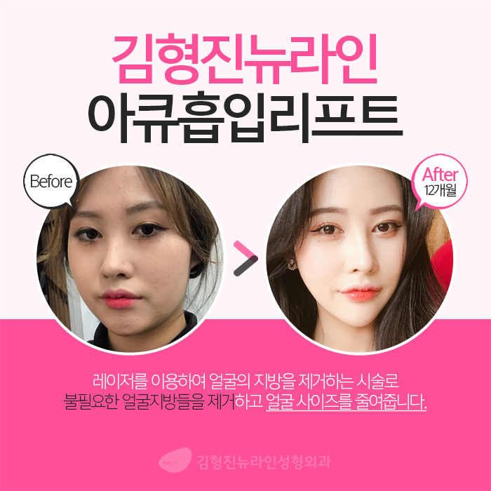 얼굴아큐스컬프 살빼는데 최고죠 관련 이미지 4