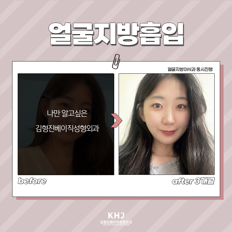 얼굴지방흡입전후 보고 가세요! 관련 이미지 7