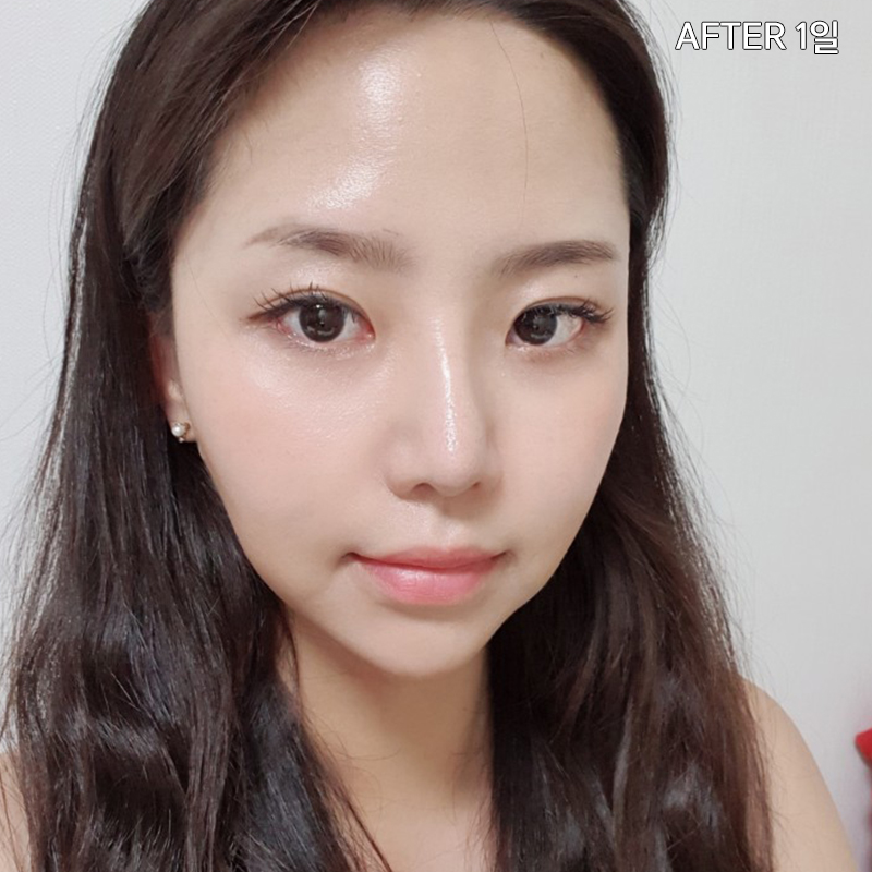 김형진베이직 얼굴지흡효과 좋다 좋아 관련 이미지 3