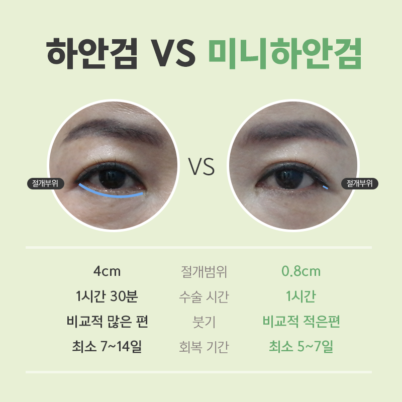 중년눈밑수술 김형진베이직에서 하셔야죠! 관련 이미지 5