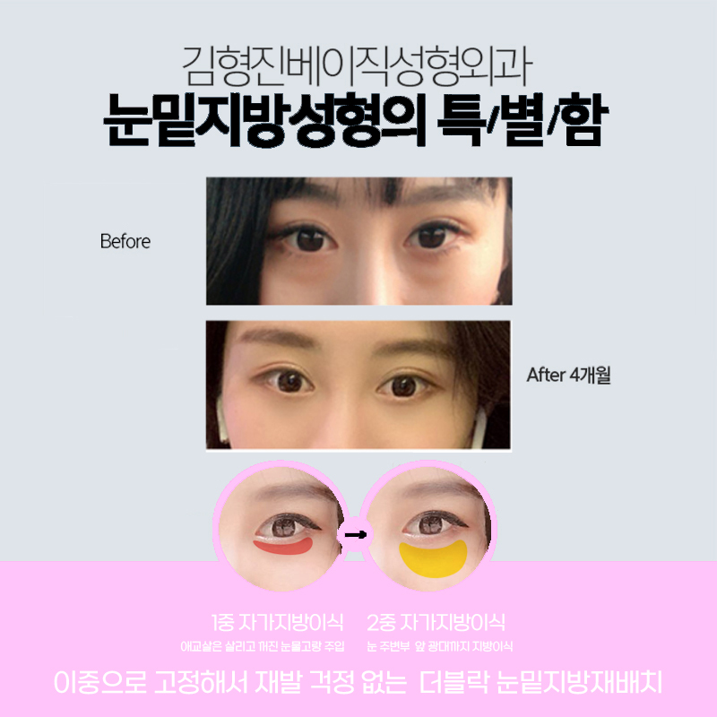 믿고 받을 수 있는 압구정눈밑지 맛집에서 성공! 관련 이미지 4