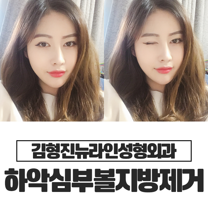 하악심부볼지방제거 안전과 부작용을 생각한다면 관련 이미지 1