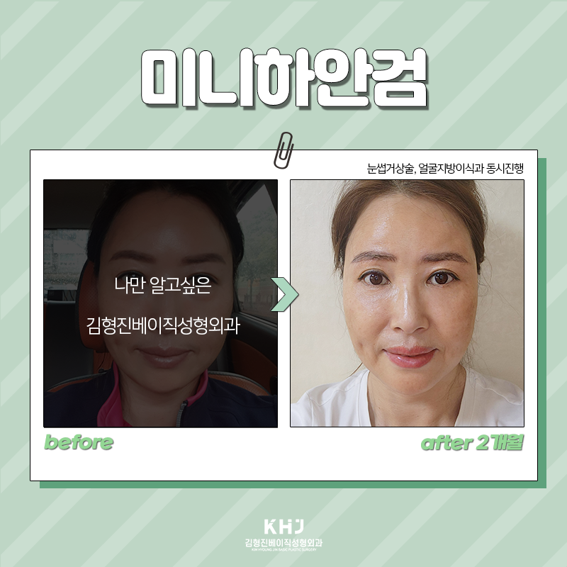 중년눈밑지방수술 어떤 방법이 있냐면요 관련 이미지 5