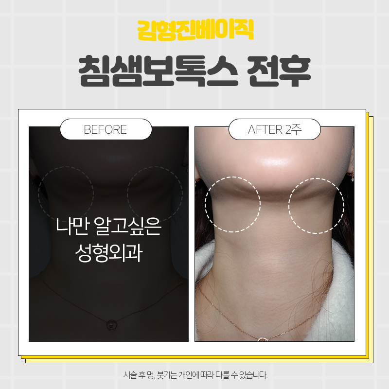 침샘보톡스후기 이걸로 종결합니다ㅠㅠ 관련 이미지 7