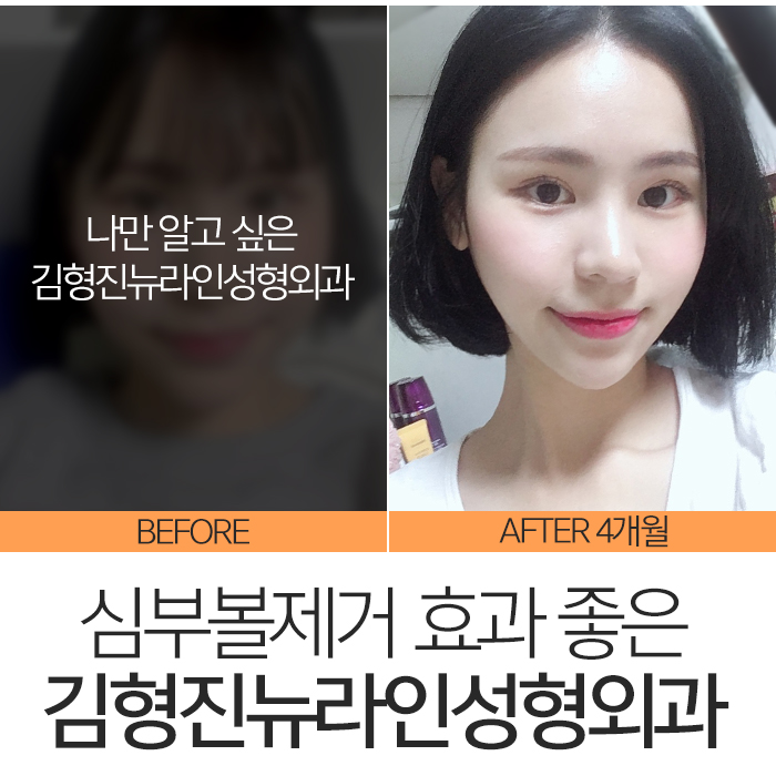 심부볼효과 확실하니까 관련 이미지 2