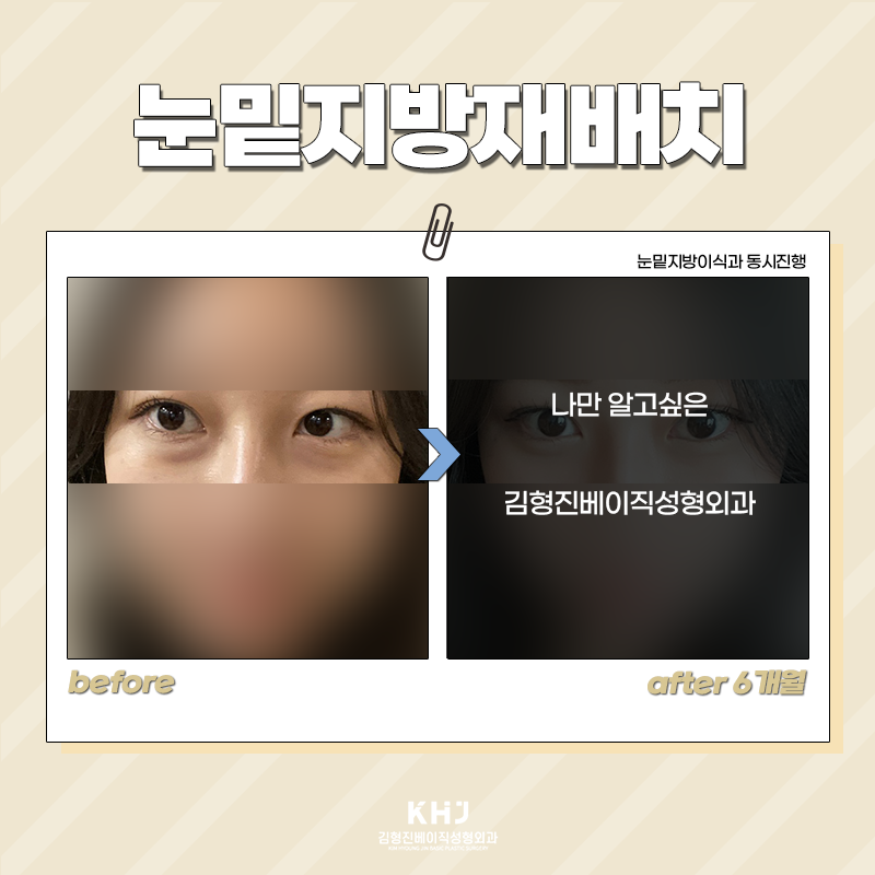 눈밑지방재배치재발 걱정 없는 이유 관련 이미지 4