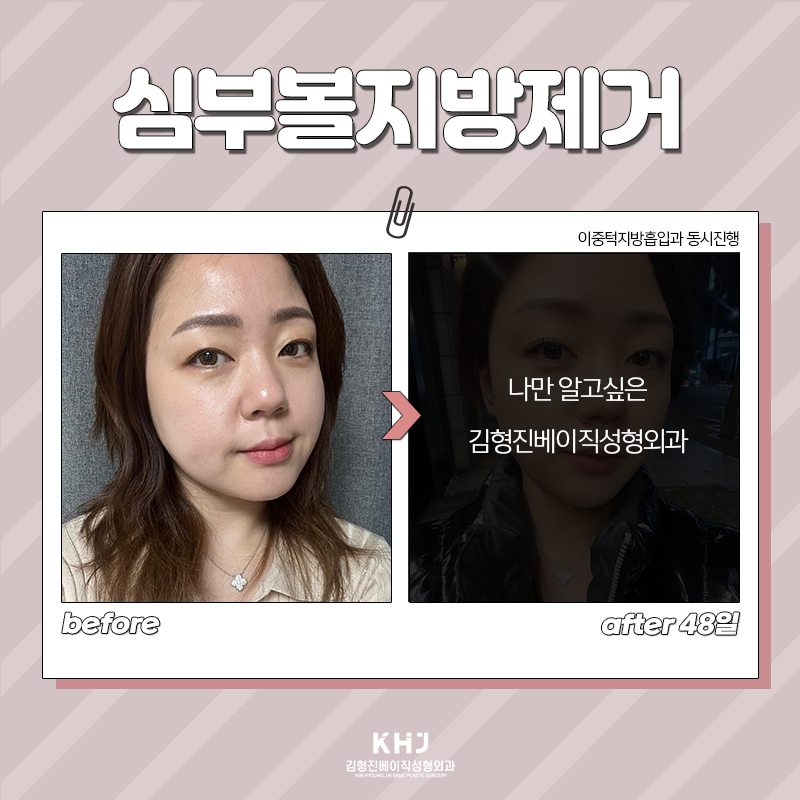 심부볼지방제거후기 궁금하셨죠? 관련 이미지 4