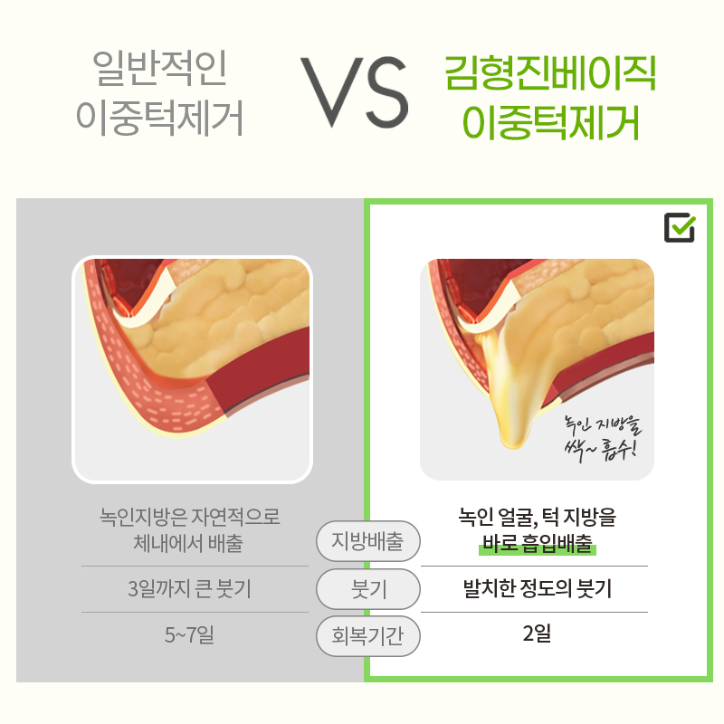 김형진베이직 얼굴지방흡입수술 변화 확실한 곳 관련 이미지 4