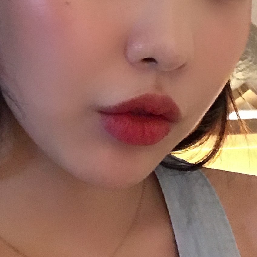 입꼬리비대칭? 입꼬리필러로 생기 있는 미소 완성! 관련 이미지 2