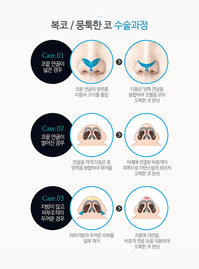 코성형종류 나에게 알맞은 것은~? 관련 이미지 2