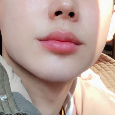 드디어 남자입꼬리필러도 잘하는 곳 찾았어요! 관련 이미지 2