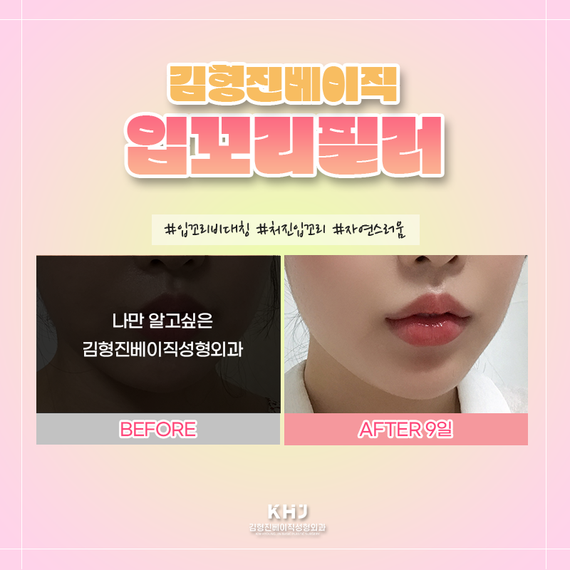 입꼬리필러전후 궁금하셨다면? 관련 이미지 4