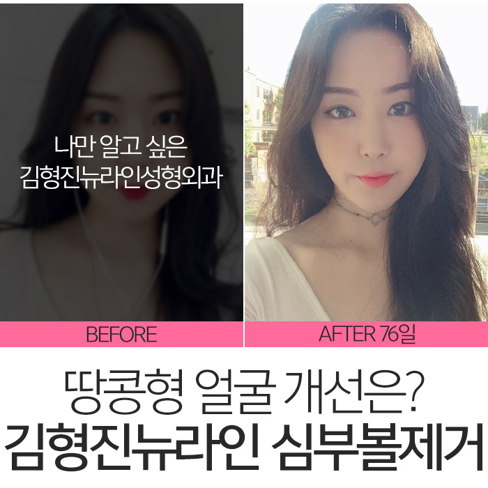 땅콩형얼굴 고민만 하고 있나요? 관련 이미지 9