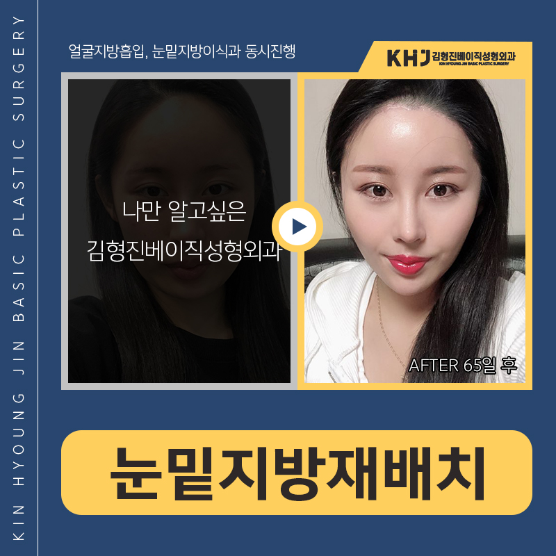 눈밑지방재배치재수술 걱정마세요 관련 이미지 7