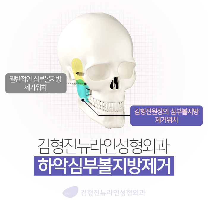 불독살 리프팅으론 안된다구요 관련 이미지 4
