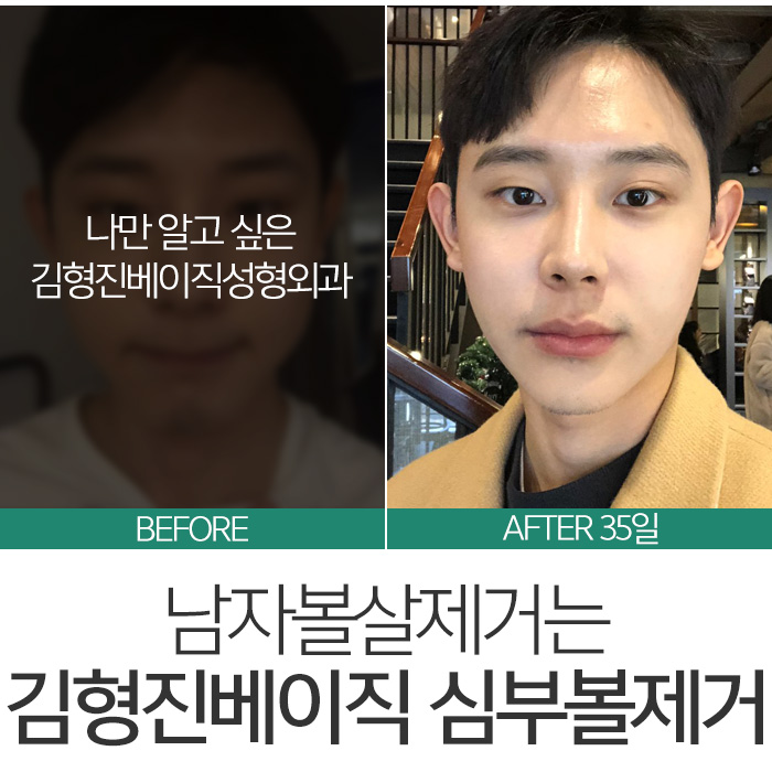 남자볼살제거 어설프게 말고 관련 이미지 3