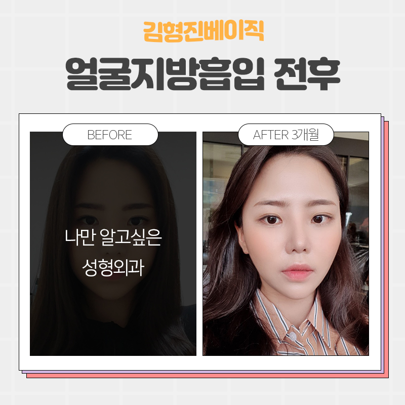 얼굴지흡후기 좋은 이유 궁금하시죠? 관련 이미지 5