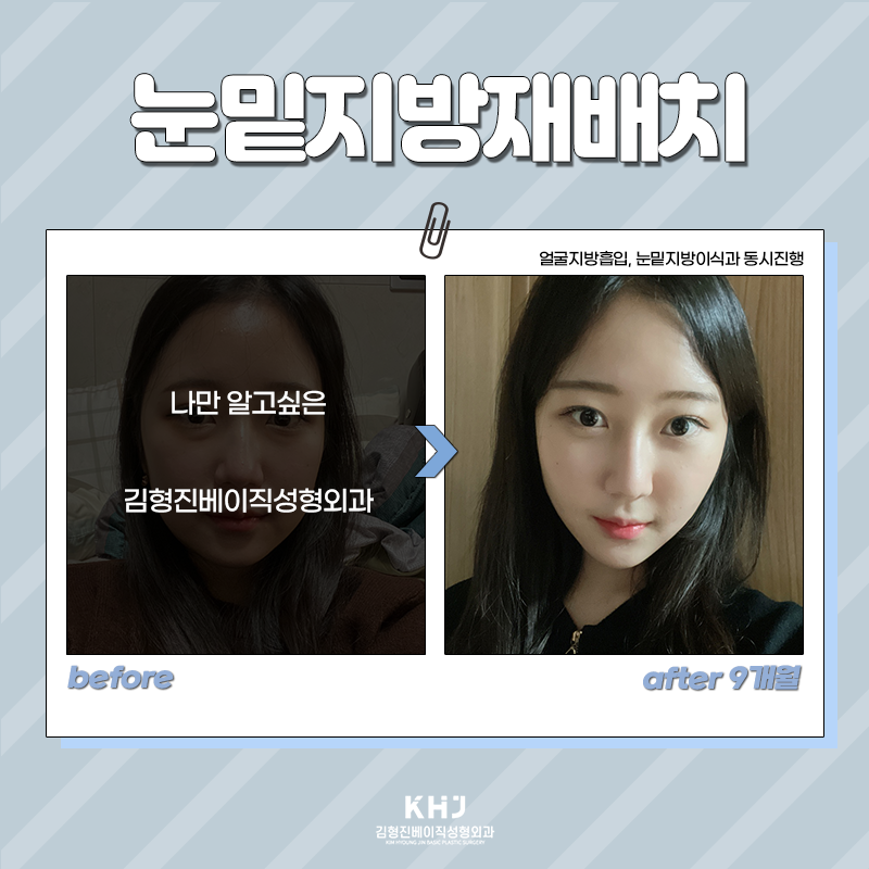 눈밑재수술 걱정 덜어놓으셔도 되는 이유 관련 이미지 3