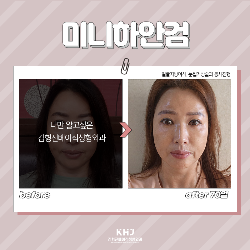 중년눈밑처짐 걱정하지 마세요! 관련 이미지 6