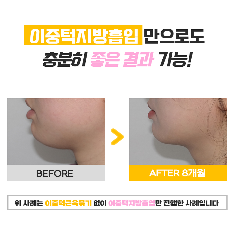 탄력있는 턱 라인, 강남이중턱제거로 지금보다 훨씬 예뻐질 수 있어요! 관련 이미지 6