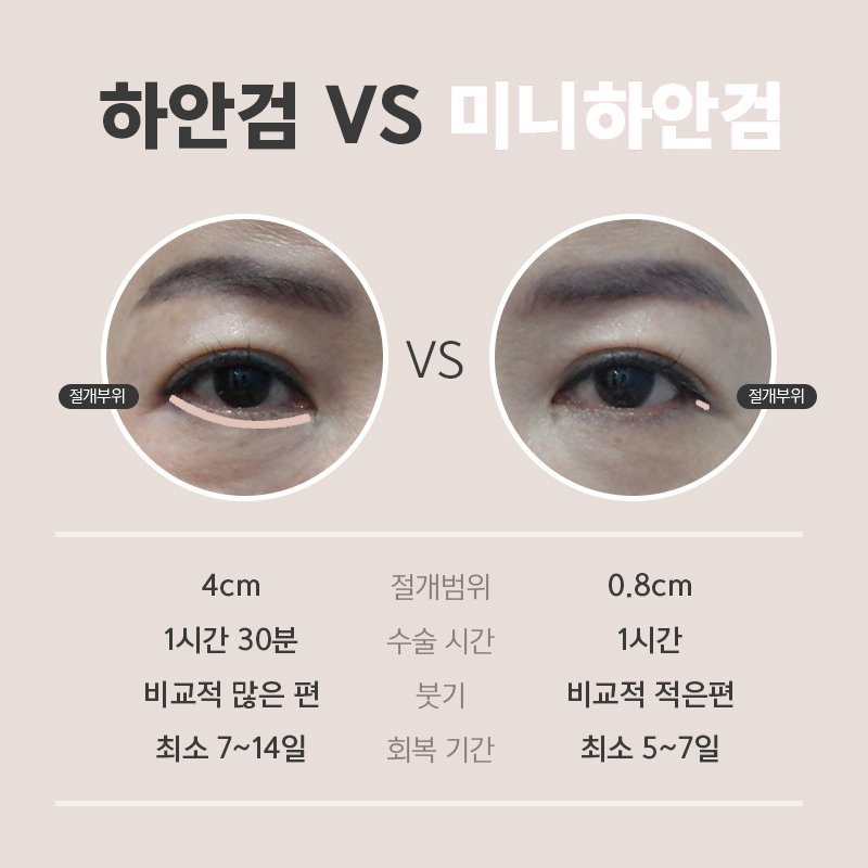 중년눈밑수술전후 잘하는 곳에서 하면 확실히 달라요 관련 이미지 4