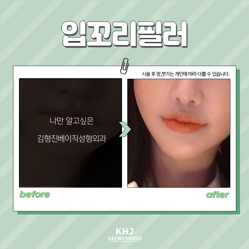 입꼬리필러전후 보여드립니다! 관련 이미지 4