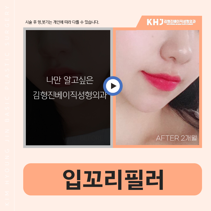 강남입꼬리필러추천 부드럽고 생기 있는 미소 만들기 관련 이미지 6