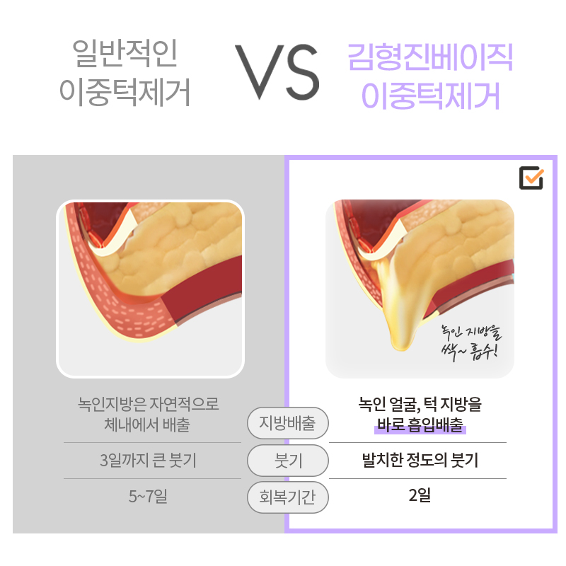 턱살지방흡입수술 받고 턱살 정리 끝! 관련 이미지 5
