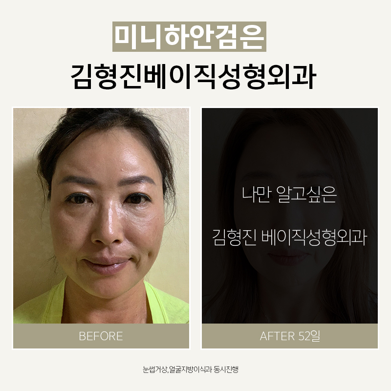 미니하안검 너무 괜찮죠? 관련 이미지 5