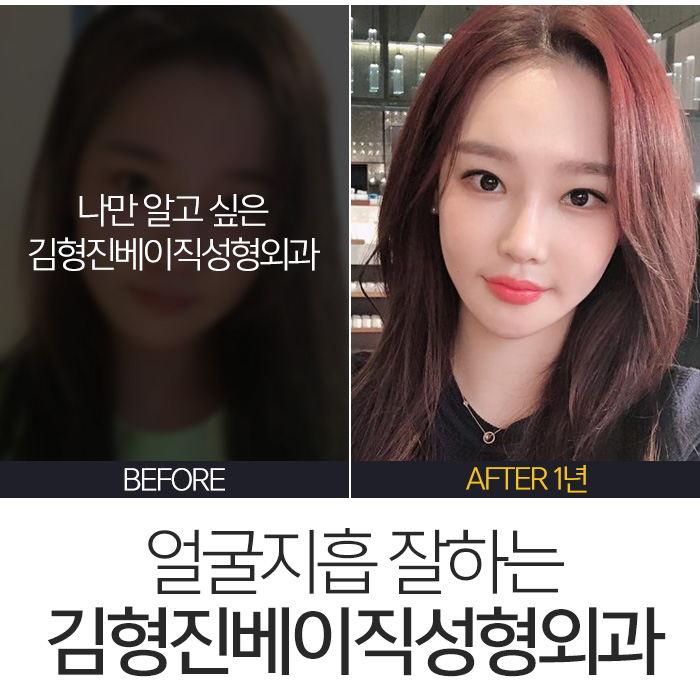 김형진베이직얼굴지흡 얼마나 잘하냐면요 관련 이미지 7