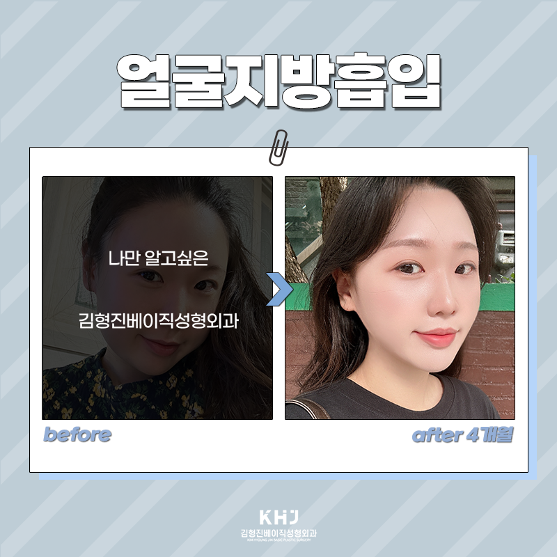 얼굴지방흡입수술 어떻게 진행되냐면요 관련 이미지 6