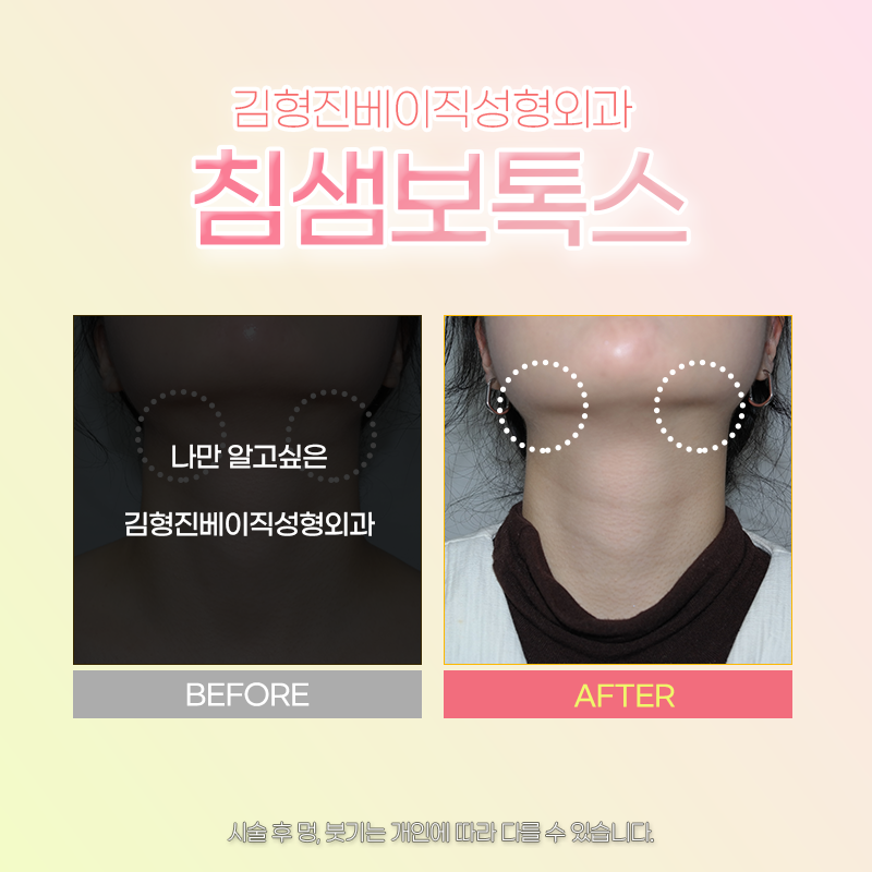 침샘보톡스효과 김형진베이직에서 보셔야죠! 관련 이미지 6