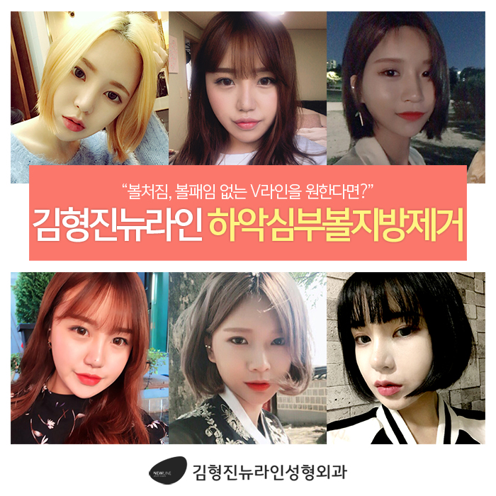 하악심부볼지방제거 어디다? 김형진뉴라인성형외과다! 관련 이미지 3