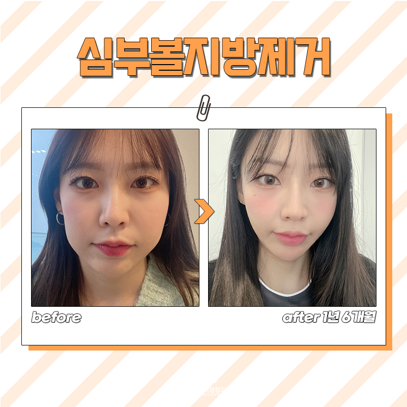 심부볼없애는법, 살짝만 변해도 얼굴형이 달라져요! 관련 이미지 6