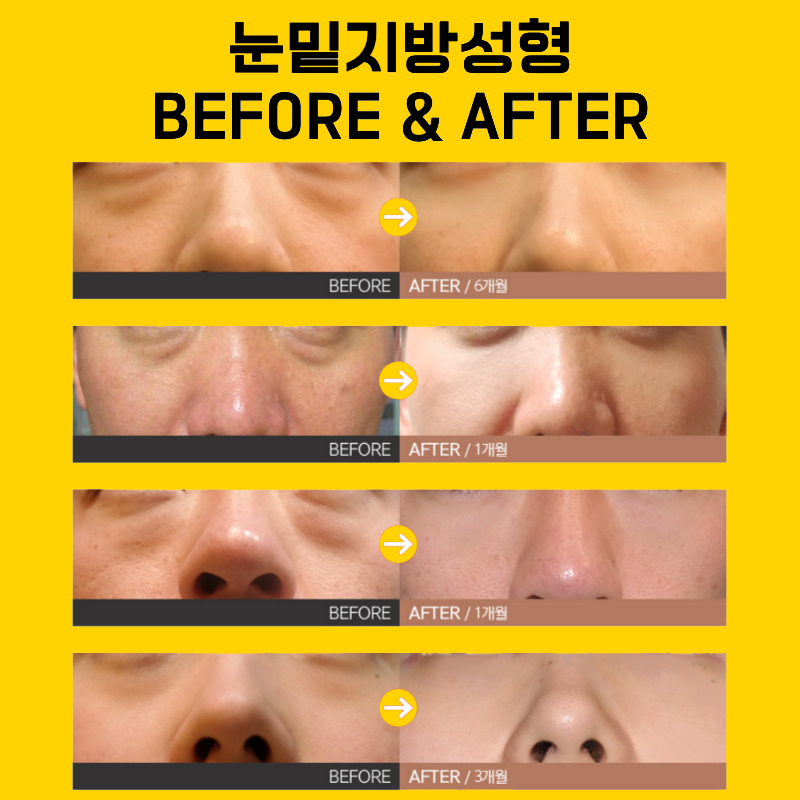 눈밑지방재배치효과 보고 눈밑 환하게 밝혔어요 관련 이미지 5