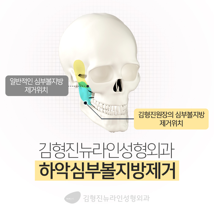심술보리프팅 김형진뉴라인에서는? 관련 이미지 4